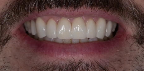 Close up of flawless teeth after full mouth reconstruction